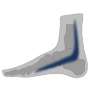 Tibialis Posterior Syndrom