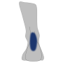 Achillessehne