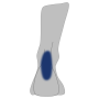 Achillessehne
